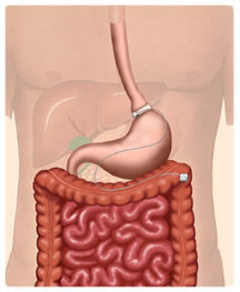 LAP-BAND� Adjustable Gastric Band 